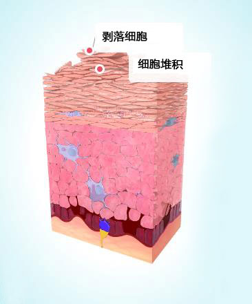 斑塊狀牛皮癬癥狀