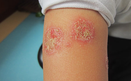 膿皰性牛皮癬是什么原因引起的