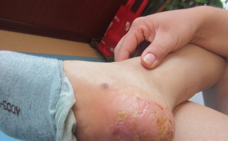 鑒別診斷膿皰性牛皮癬