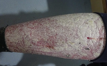 怎么治療膿皰型銀屑病