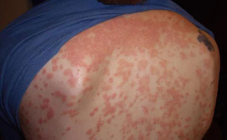 腸狀牛皮頑癬圖片癥狀