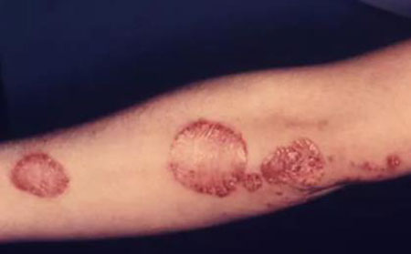 多發性牛皮頑癬斑塊圖片癥狀