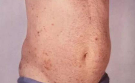 輕度腹瀉型牛皮頑癬圖片癥狀