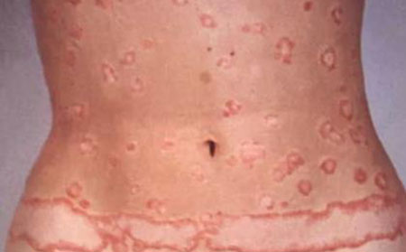 軀干斑塊狀牛皮頑癬圖片癥狀