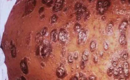 重度咽喉牛皮頑癬圖片癥狀