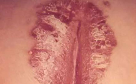 臀裂斑塊狀牛皮頑癬圖片癥狀