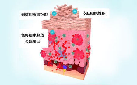 銀屑頑癬癥狀種類圖片