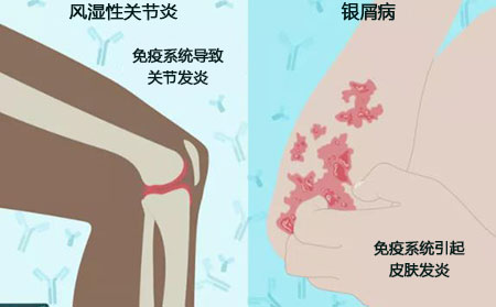 銀屑頑癬癥狀嚴重程度