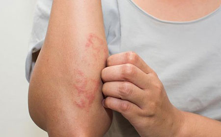 斑塊狀牛皮癬病因-感染和皮膚損傷