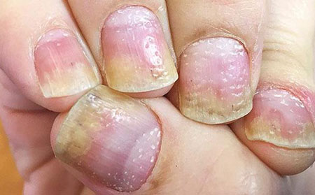 牛皮膚癬圖片癥狀-指甲的變化
