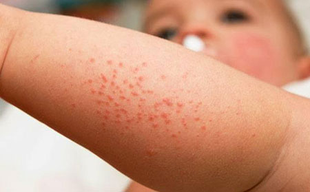 牛皮膚癬癥狀初期-皮膚上的小紅色斑點(diǎn)