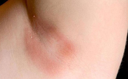 牛皮膚癬癥狀圖片-皮膚褶皺