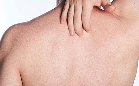 牛皮膚癬早期圖片-脫皮皮疹