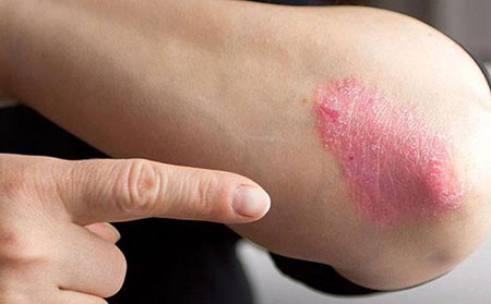 牛皮膚癬初期圖片-紅皮疹