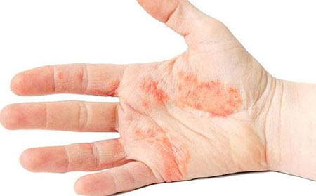 初期牛皮膚癬癥狀-水皰膿皰