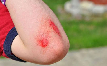 牛皮癬長期瘙癢是什么原因-皮膚受傷