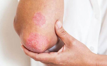 銀屑病關節炎早期癥狀