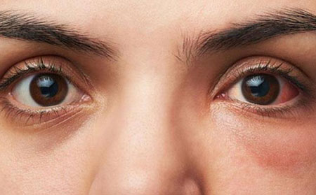 銀屑病性關節炎癥狀