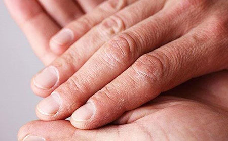 銀屑病型關節炎癥狀