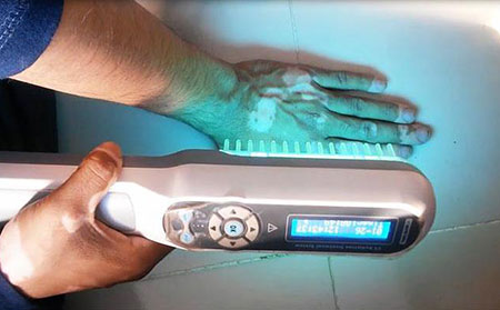 紫外線B(UVB)光療