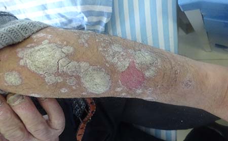 胳膊銀屑病癥狀,胳膊長銀屑病什么樣