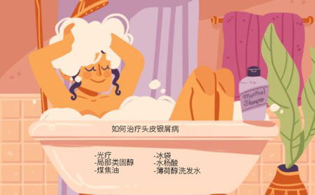 頭皮銀屑癬怎么治療