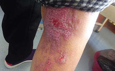 銀屑病治療,銀屑病要長期治療嗎,銀屑病醫院