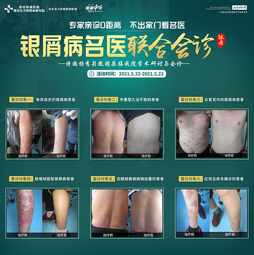 5月22-23日銀屑病專家會(huì)診活動(dòng)在濰坊東方銀屑病研究院舉行