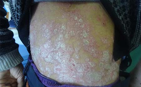 牛皮癬癥狀,得牛皮癬什么癥狀,濰坊牛皮癬專科醫院