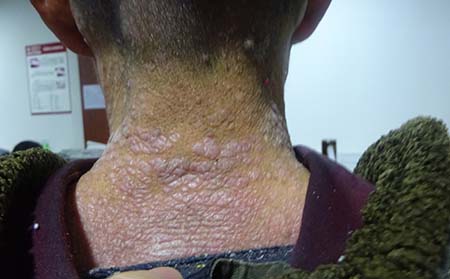 治牛皮癬用藥,用什么藥去治牛皮癬,牛皮癬治療醫(yī)院