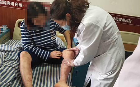 德州可以治好銀屑病嗎