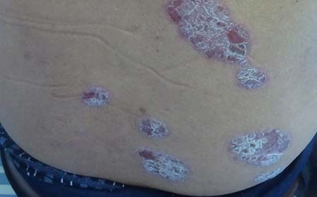 牛皮癬前期癥狀,前期牛皮癬什么癥狀,濰坊牛皮癬專科醫院