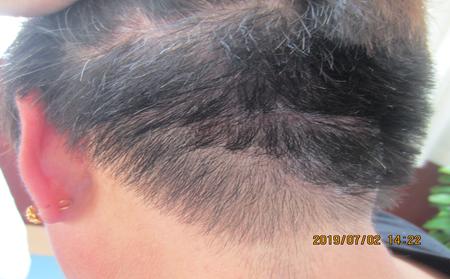 頭皮牛皮癬銀屑病