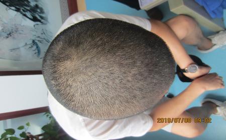 頭皮牛皮癬銀屑病怎么治療