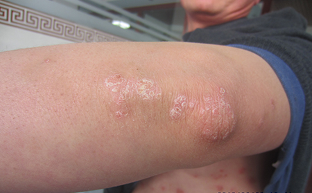 手臂牛皮癬銀屑病