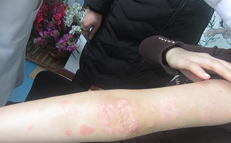 牛皮癬銀屑病癥狀怎么治療