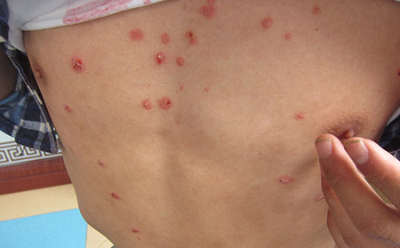 牛皮癬銀屑病的類型