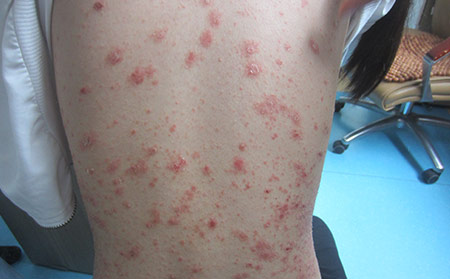 牛皮癬銀屑病并發(fā)癥危害