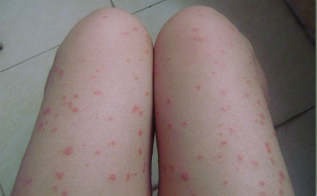 兒童銀屑病治療,兒童有銀屑病怎樣治,銀屑病醫(yī)院