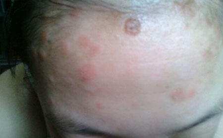 兒童銀屑病的護理,兒童銀屑病的防治,銀屑病治療醫(yī)院