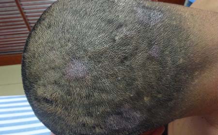 頭部牛皮癬治療,頭部有牛皮癬怎樣治,牛皮癬治療醫院