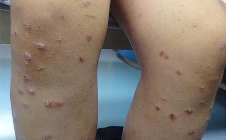 女性銀屑病治療,怎樣治女性銀屑病,濰坊東方銀屑病研究院