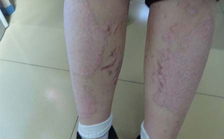 兒童牛皮癬怎么辦,兒童有牛皮癬怎么辦,濰坊牛皮癬專科醫院