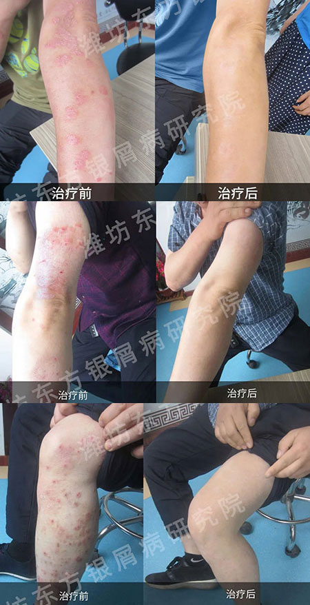 濰坊東方銀屑病研究院牛皮癬銀屑病治療康復對比圖