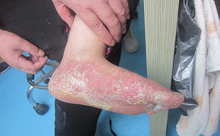 銀屑病關節炎(PA)癥狀