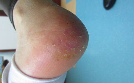 牛皮膚癬圖片癥狀