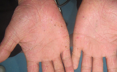 牛皮膚癬癥狀發病原因