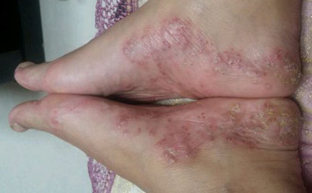 牛皮膚癬或銀屑病關節炎分辨