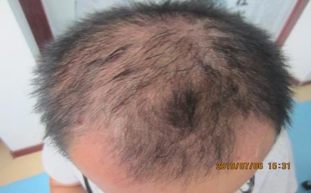 頭皮銀屑病治療