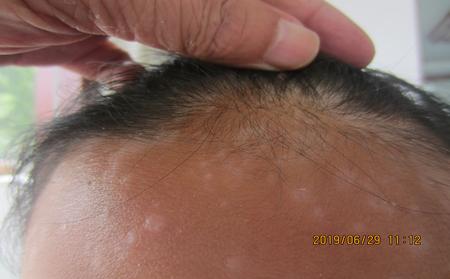 頭皮銀屑病治療的藥